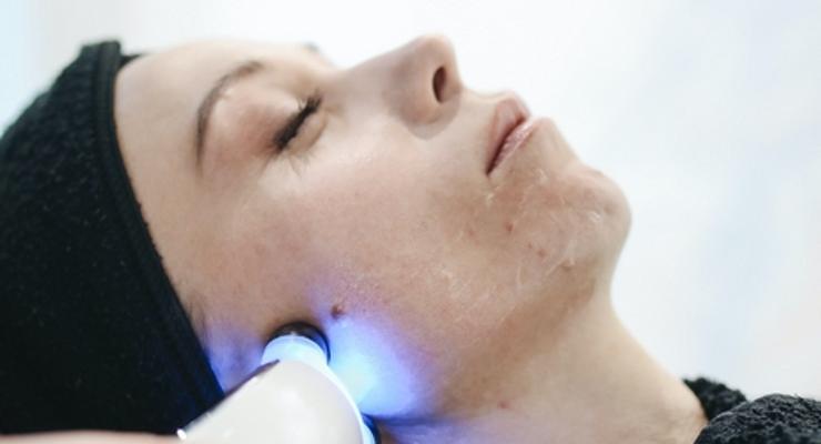 Mezoterapia mikroigłowa - sposób na odmłodzenie skóry